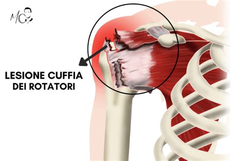 Lesione Cuffia Dei Rotatori Guida Ai Sintomi E Soluzioni