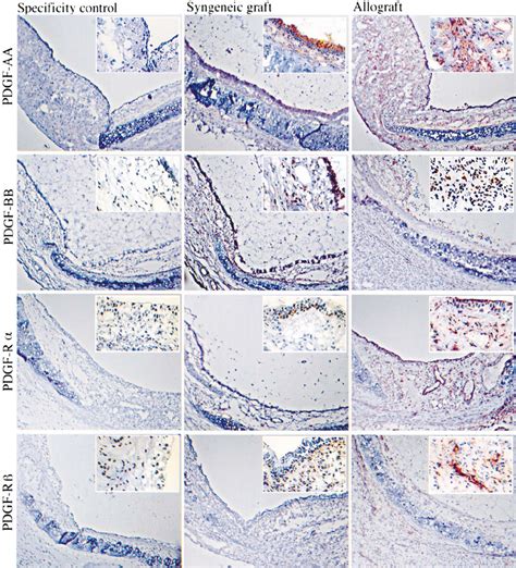 Photomicrographs Of Immunoperoxidase Staining For Pdgf Ligand And