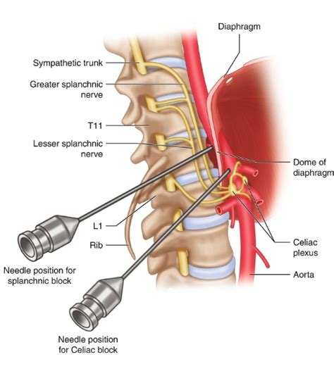 Celiac Plexus Block / Neurolysis: Cancer Pain Relief | Hawthorne ...
