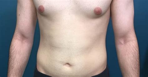 Before And After 1 Month Post Op Gynecomastia Removal Super Happy With Results So Far Cant