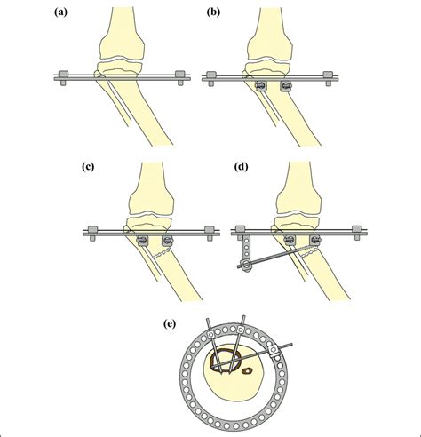 Fixation Of Ring Fixator To Proximal Tibia A Transverse Wire Download Scientific Diagram