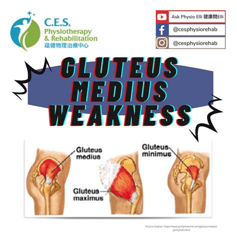 Gluteus Medius Weakness