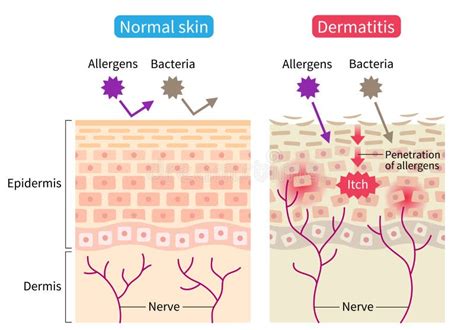 特应性皮炎湿疹和正常皮肤细胞图 健康护肤概念 向量例证 插画 包括有 医疗 炎症 湿疹 护拦 253085703