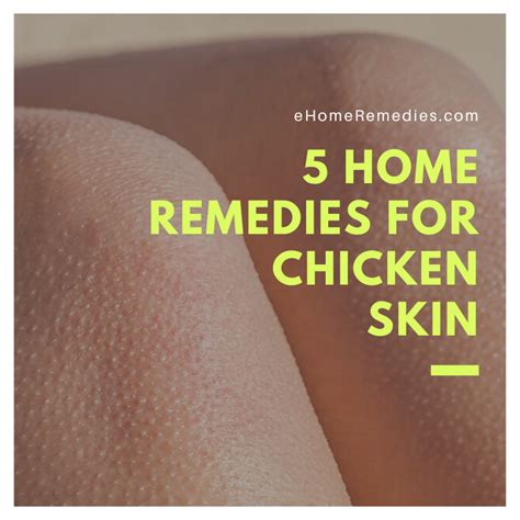 5 Home Remedies For Chicken Skin