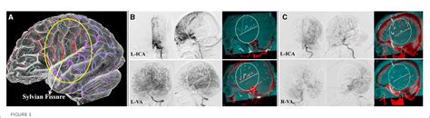 Figure 1 From Analyzing Characteristics Of Collateral Flow To Parasylvian Cortical Arteries By