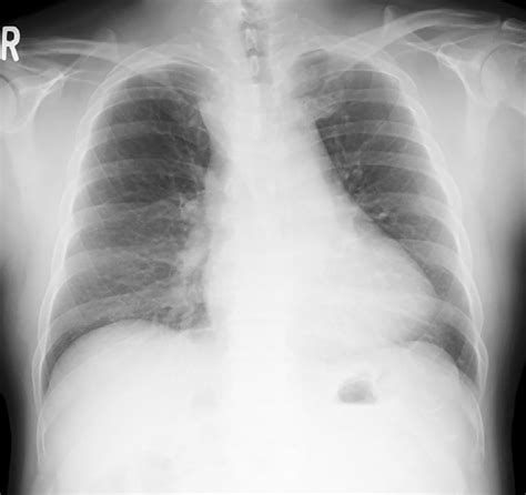 Figure1chest X Ray Findings The Widened Superior Mediastinum Is Download Scientific Diagram