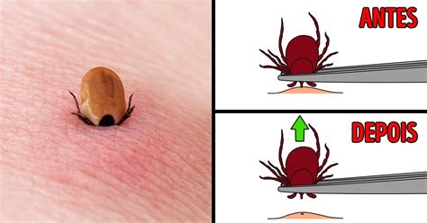Como tirar carrapatos segurança e de maneira eficaz Incrível