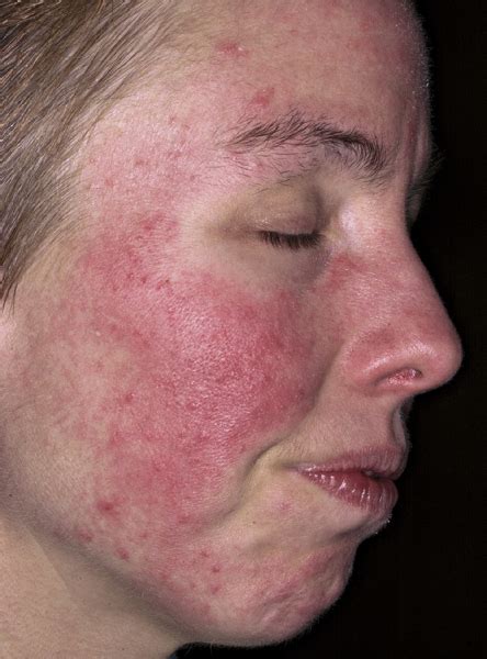 Acne Rosacea - Causes, Symptoms, Treatment, Pictures, Diet | Diseases ...