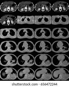 Computed Tomography Ct Scan Chest Abdomen Stock Photo