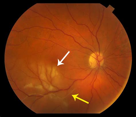 Retinal Vasculitis