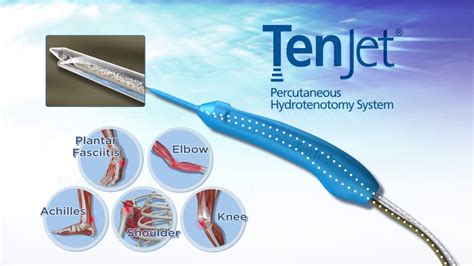 Percurtaneous Tenotomy Tenjet Susquehanna Orthopaedic Associates