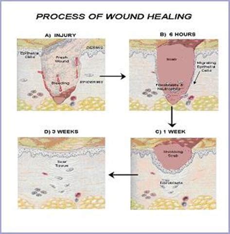 Flashcards Table on Wounds And Wound Healing