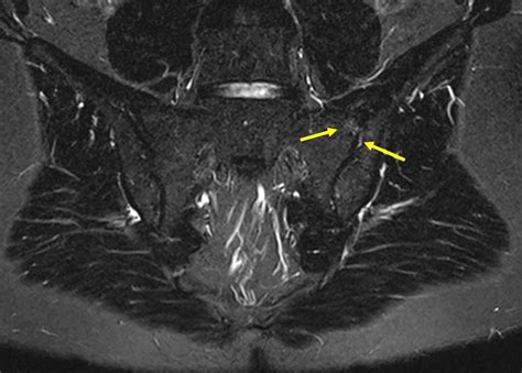 Axiale Spondyloarthritis MRT Diagnostik In Der Praxis Rheumatologie