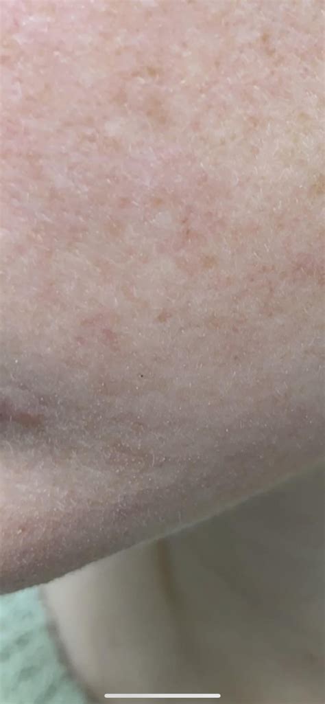 Dry red rough rash : r/skin