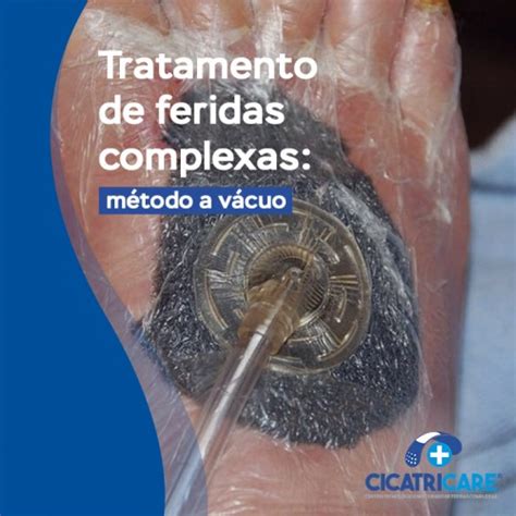 Tratamento De Feridas Complexas M Todo A V Cuo Cicatricare Ararangu