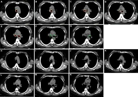 Frontiers Stent Loaded With Radioactive Iodine 125 Seeds For Adenoid