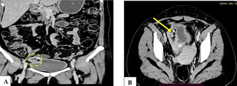 Cect Of The Abdomen And Pelvis Right Adnexal Mass With Bladder Download Scientific Diagram