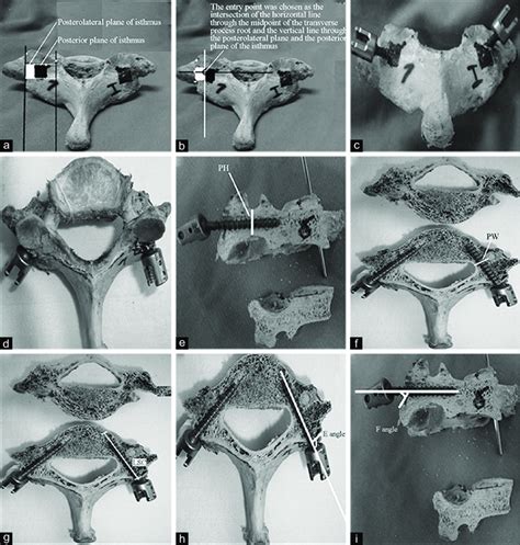 Pedicle Screw Placement And Measurements A The Isthmus Posterior