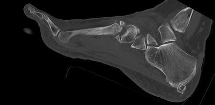 Anterior Calcaneal Process Fracture Radiology Case Radiopaedia Org