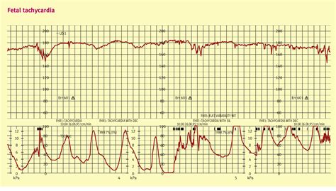 Figure From Intrapartum Fetal Surveillance Semantic Scholar