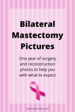 Bilateral Mastectomy Pictures Josie S Journey