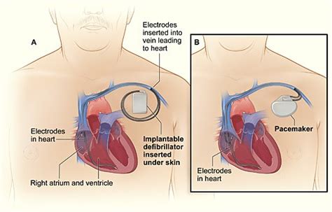 Defibrillators - What are Defibrillators? | NHLBI, NIH