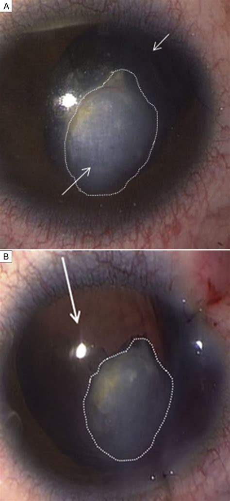 Cataract Surgery In Children With Congenital Keratolenticular Adhesion