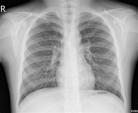 Detecting pneumonia on X-ray images — ConvNets and Transfer Learning ...