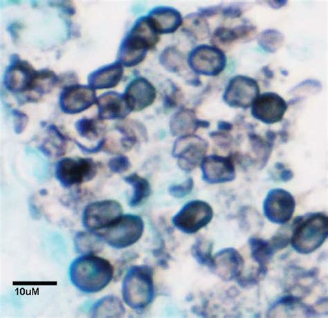 P Carinii Ascicyst Forms Stained With Methenamine Silver Black Download Scientific Diagram