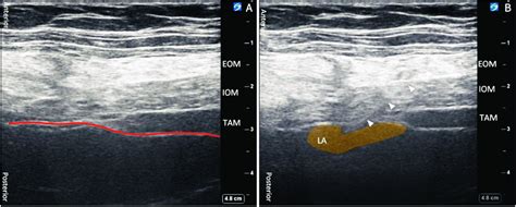 Sonoanatomy For Transversalis Fascia Plane Block A The Red Line Download Scientific Diagram