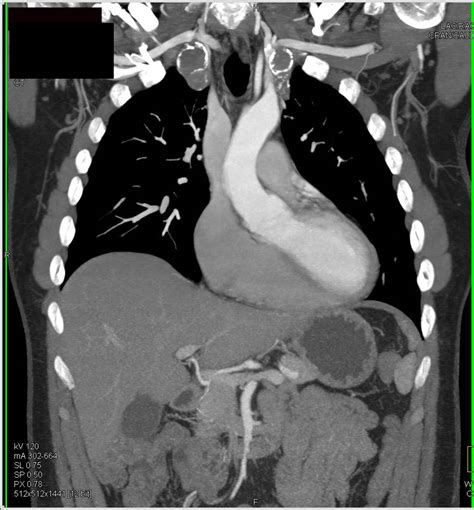 Bilateral Subclavian Artery Aneurysms With Large Right Renal Artery