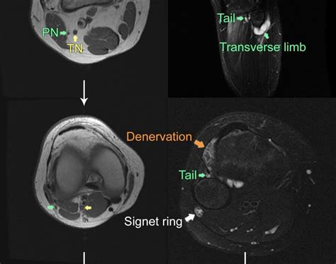 Roentgen Ray Reader Peroneal Intraneural Ganglion Cyst