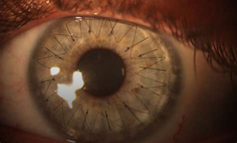 Cornea Transplant Keratoplasty Risks Treatment And Recovery