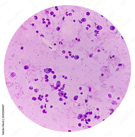 Bone Marrow Study A Megakaryocyte Is A Large Bone Marrow Cell With A