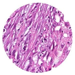 Types of Mesothelioma Cancer Based on Cell, Location & Rarity