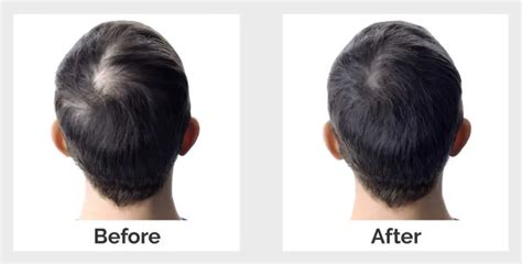 Genetic Hair Loss Treatment Svenson