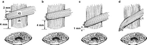 Inferior Oblique Muscle Weakening Procedures Ento Key