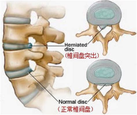 撥開迷霧：腰椎管狹窄和腰椎間盤突出症二三事 每日頭條