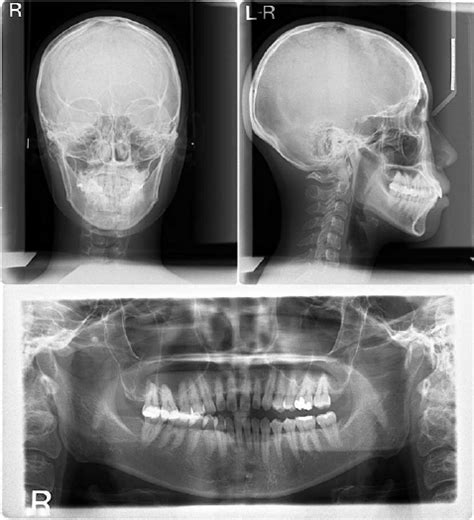 Pretreatment Postero Anterior Lateral Cephalometric And Panoramic