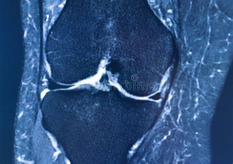 Knee injury mri mcl tear stock image. Image of surgery - 169799021