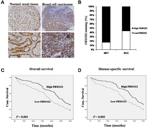 Expression Of Fbxo Was Down Regulated In Rcc Tissues And Positive