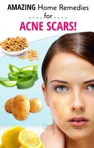 Home Remedies for Acne Scars : Acne Scars Treatments