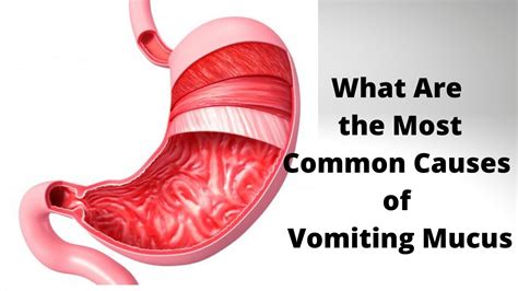 What Are The Most Common Causes Of Vomiting Mucus Youtube