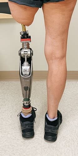 What Is Osseointegration Osseointegration Limb Replacement Cu Denver