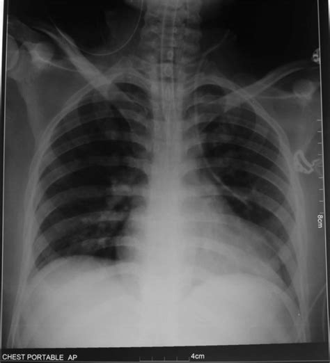 Chest Radiograph Posterior Anterior View Showing Malpositioned Central