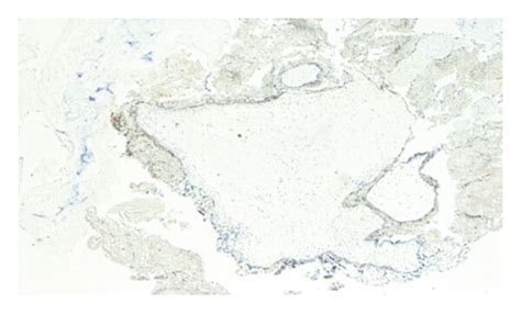 Complete Hydatidiform Mole Slides Histology And Immunohistochemistry