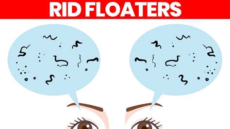 Eye Floaters What Are They How To Get Rid Of Them