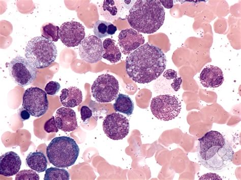 Idiopathic Hypereosinophilic Syndrome 1