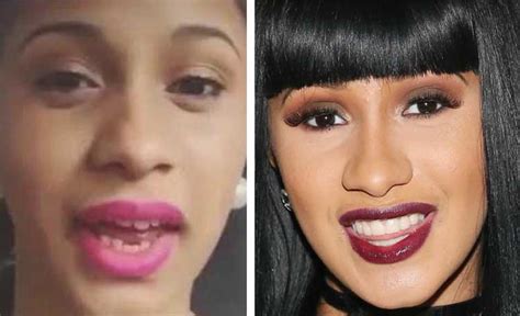 Cardi b teeth before and after: cost, surgery, pictures