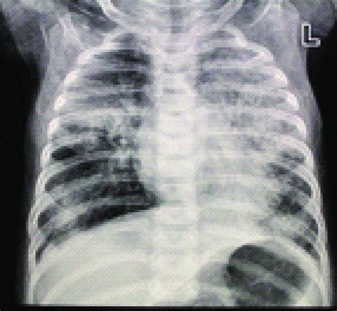 Case 1 Chest Radiography Demonstrating Bilateral Ground Glass Pulmonary